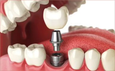 Implantes Dentários